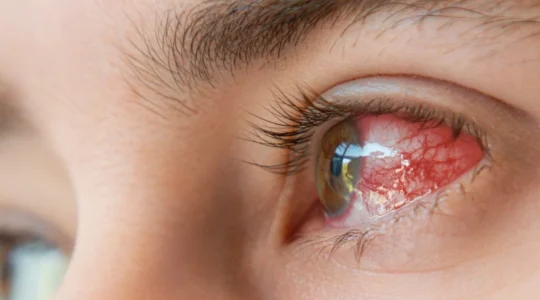 les-lentilles-ultra-peuvent-elles-limiter-les-demangeaisons-oculaires